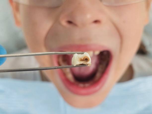 Best Emergency Wisdom Teeth Removal in Buford, GA